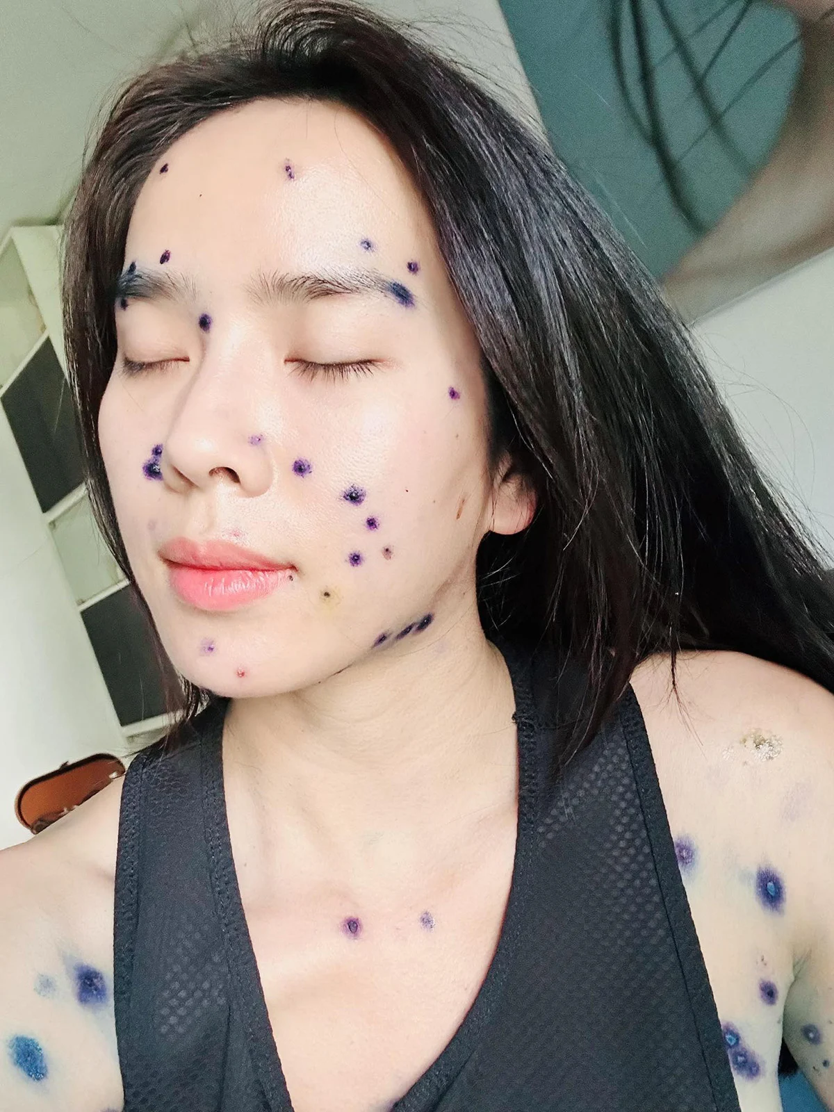 Bella Mai trong thời gian điều trị căn bệnh thủy đậu