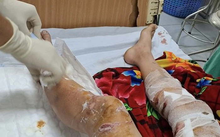 Chấn thương tại vùng chân của Nam sinh